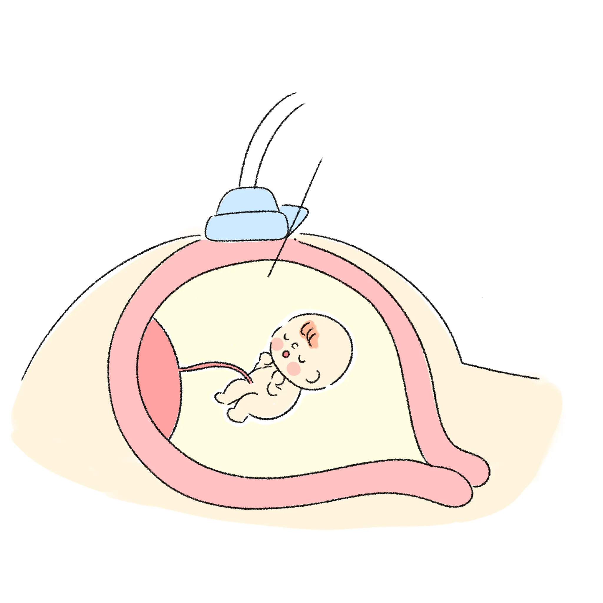 イメージ:羊水検査