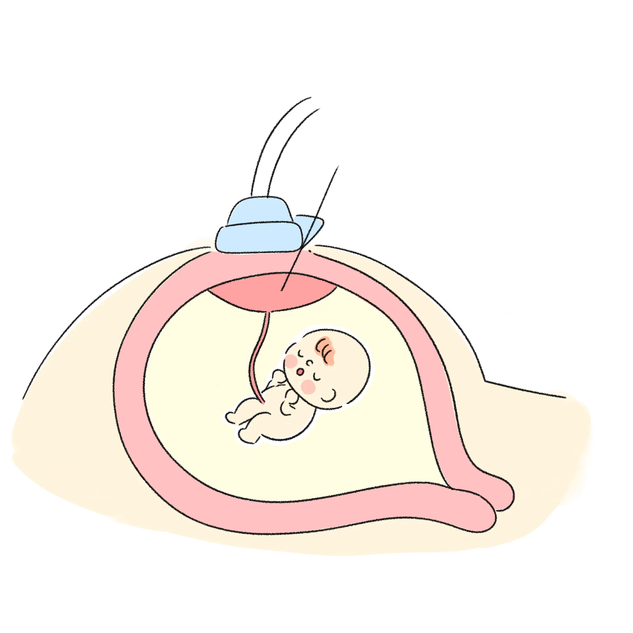 イメージ:絨毛検査