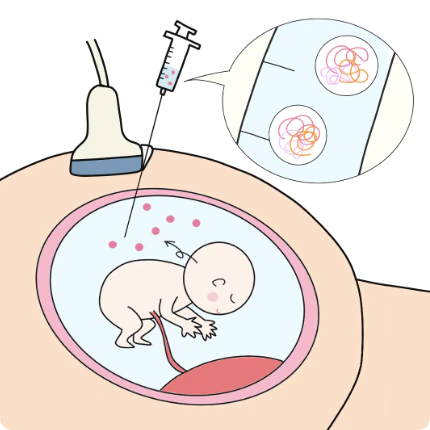 羊水検査の方法イメージ