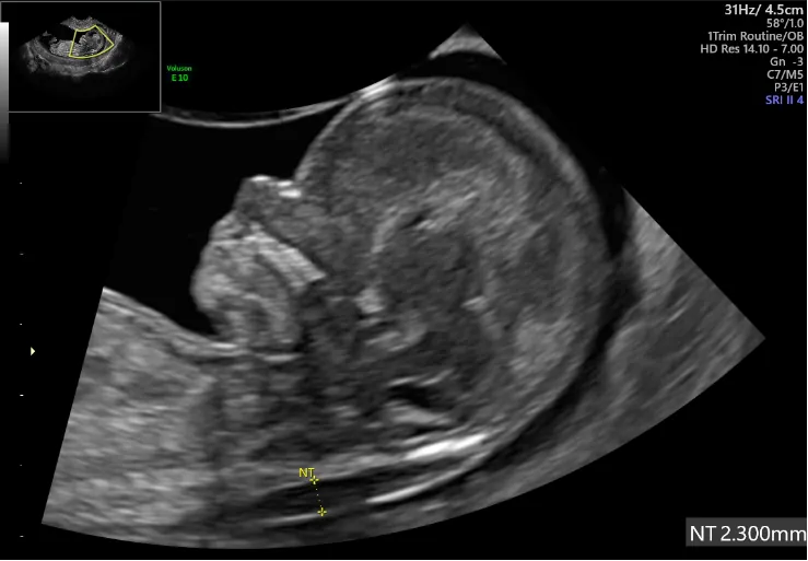 精密超音波画像