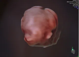 精密超音波画像